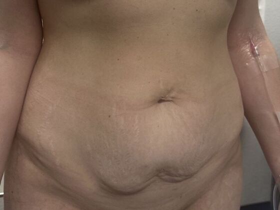 Tummy Tuck (Abdominoplasty): Case 583 - Before