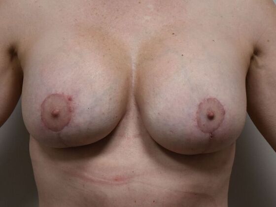 Breast Augmentation w/ Lift: Case 639 - After