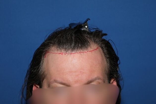 Hair Transplants Case 13 - FUE Hair Transplant for Hairline Reconstruction - Before
