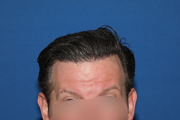 Hair Transplants Case 13 - FUE Hair Transplant for Hairline Reconstruction - After