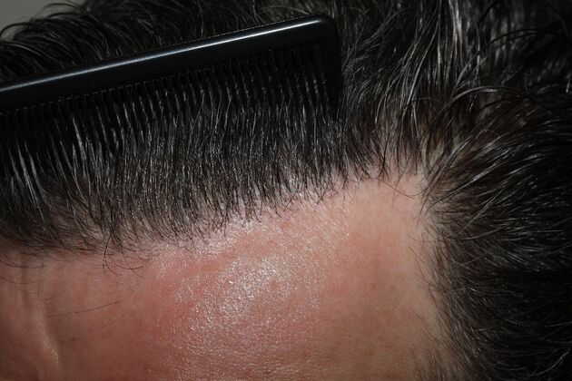 Hair Transplants: Case 13 - FUE Hair Transplant for Hairline Reconstruction - A close-up view of the transplanted hairline highlighting density and natural appearance.