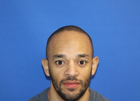 Hair Transplants Case 14 - Afro Textured Hair - Before