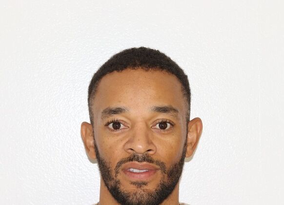 Hair Transplants Case 14 - Afro Textured Hair - After