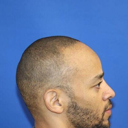 Hair Transplants: Case 14 - Afro Textured Hair - Before