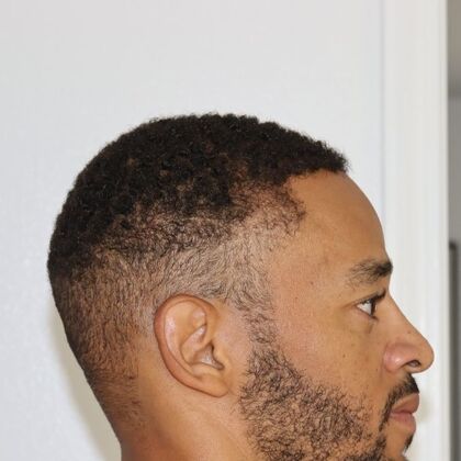 Hair Transplants: Case 14 - Afro Textured Hair - After