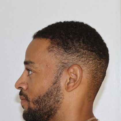 Hair Transplants: Case 14 - Afro Textured Hair - After