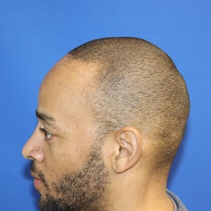 Hair Transplants: Case 14 - Afro Textured Hair - Before