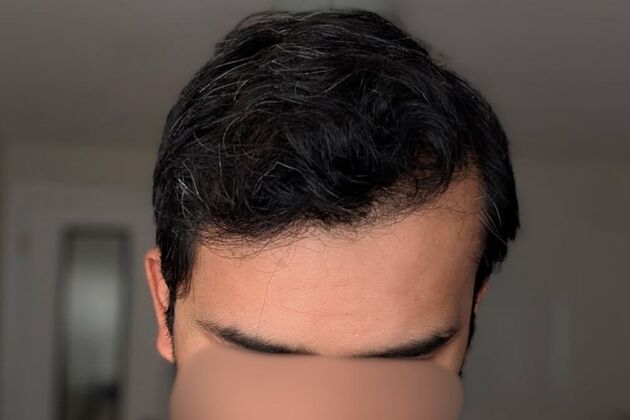 Hair Transplants Case 15 - FUE Hair Transplant  - After