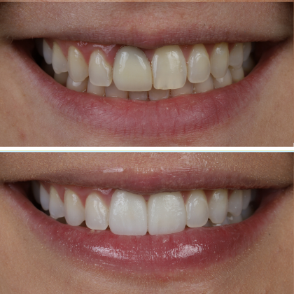 Minimal Prep Porcelain Veneers Danielle - Before