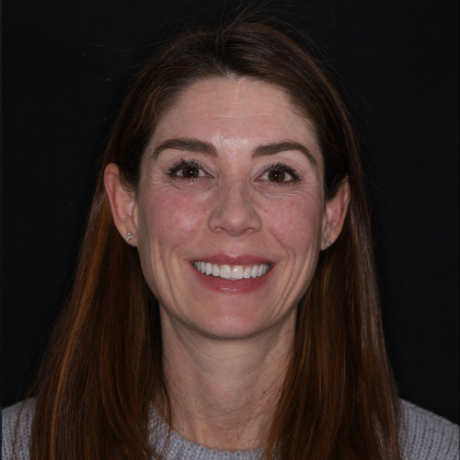 Minimal Prep Porcelain Veneers Philippa - After