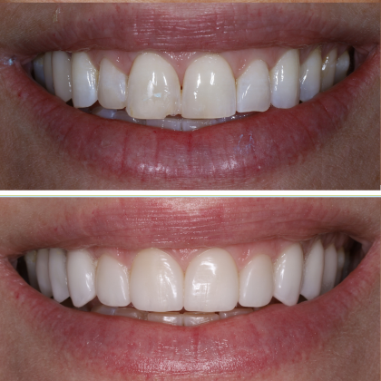 Minimal Prep Porcelain Veneers Philippa - Before