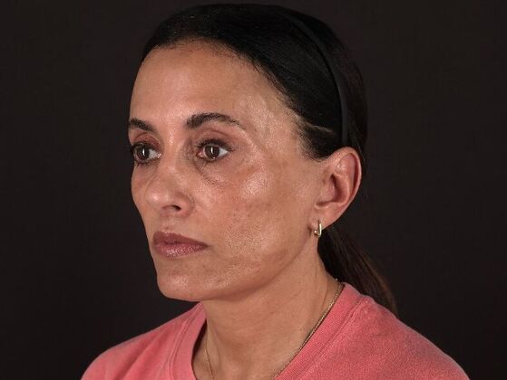 Face & Neck Lifts: Case 60 - After