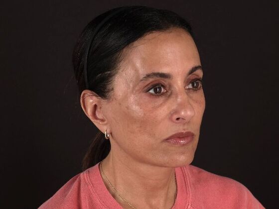 Face & Neck Lifts: Case 60 - After