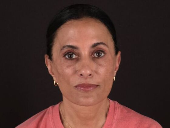 Face & Neck Lifts: Case 60 - After