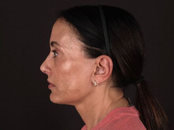 Face & Neck Lifts: Case 60 - After