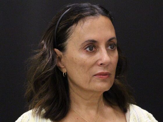 Face & Neck Lifts: Case 60 - Before