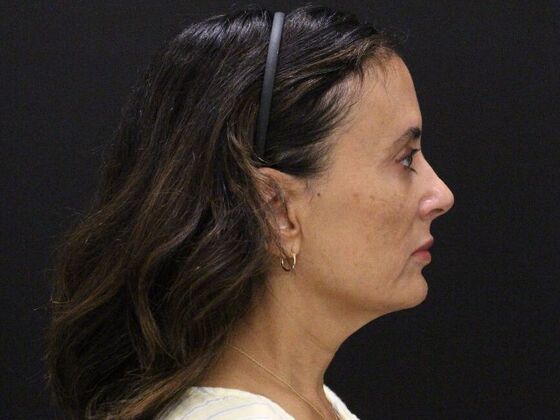 Face & Neck Lifts: Case 60 - Before