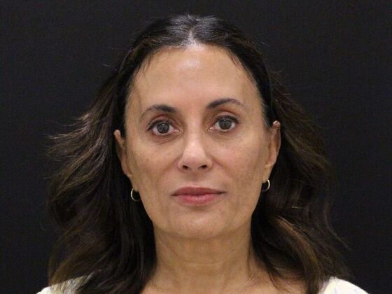 Face & Neck Lifts: Case 60 - Before