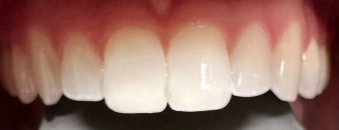 Chipped Tooth Repair Case 1 - After