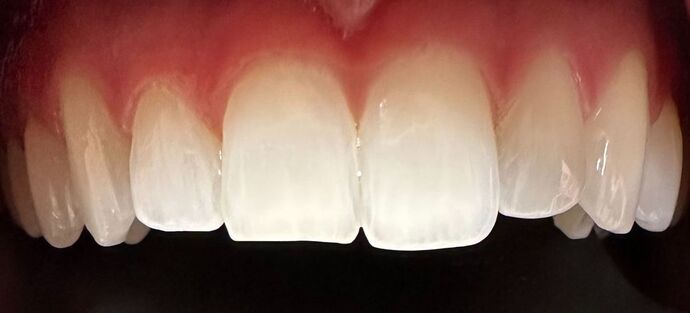 Chipped Tooth Repair Case 1 - Before