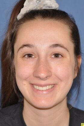 Rhinoplasty crooked nose after rhinoplasty elsewhere - Before