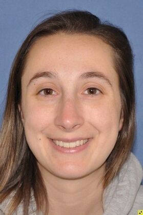 Rhinoplasty crooked nose after rhinoplasty elsewhere - After