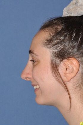 Rhinoplasty: crooked nose after rhinoplasty elsewhere - Before
