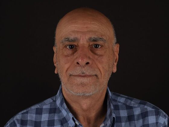 Face & Neck Lifts: Case 6 - After