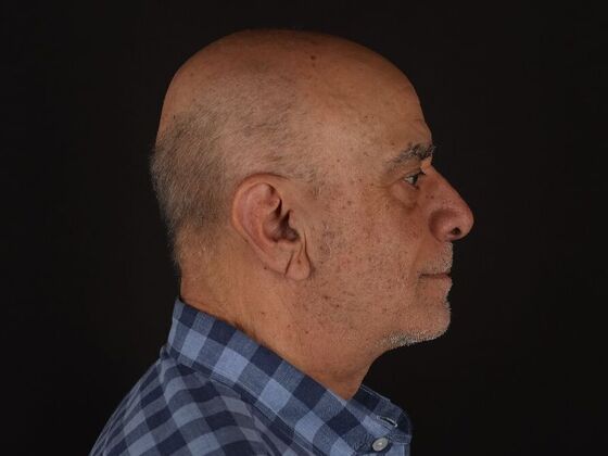 Face & Neck Lifts Case 6 - After