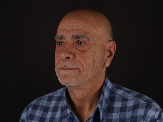 Face & Neck Lifts: Case 6 - After