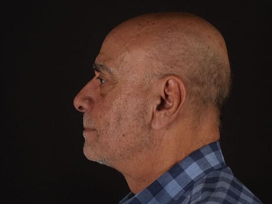 Face & Neck Lifts: Case 6 - After