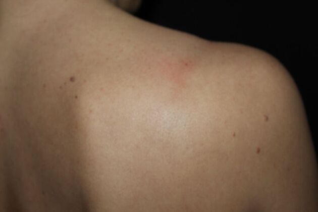 Laser Tattoo Removal Case 47 - After