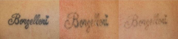 Laser Tattoo Removal Case 47 - Before