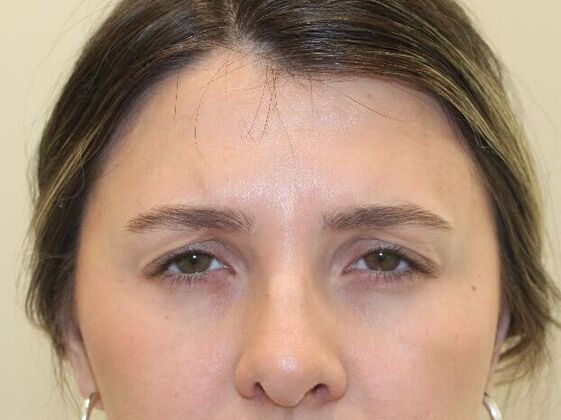 Injectables: Case 102 - After