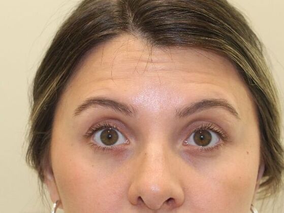 Injectables Case 102 - After