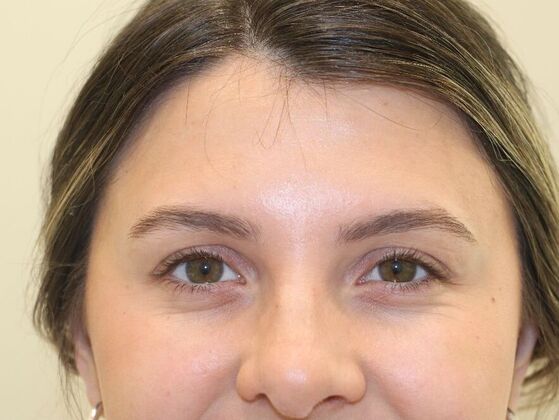 Injectables: Case 102 - After