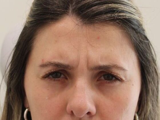 Injectables: Case 102 - Before