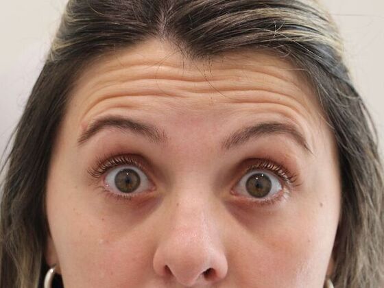 Injectables Case 102 - Before