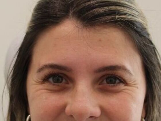 Injectables: Case 102 - Before