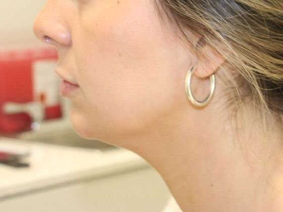 Injectables: Case 103 - After