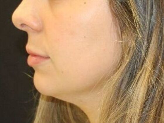 Injectables: Case 103 - Before