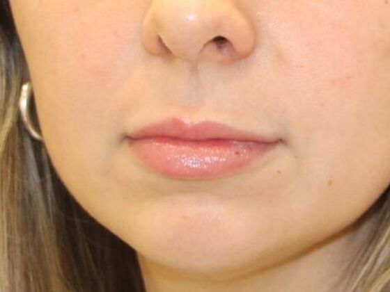 Injectables Case 103 - Before