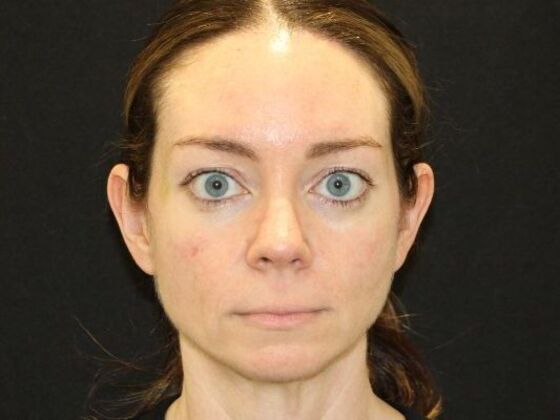 Injectables Case 104 - Before