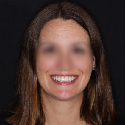 No Prep Porcelain Veneers Marie - After