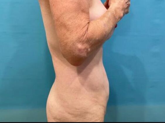 Tummy Tuck: Case 8 - Before