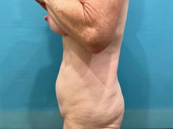 Tummy Tuck: Case 8 - Before