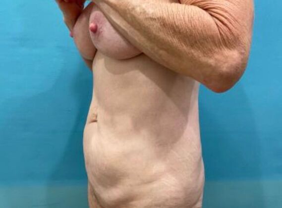 Tummy Tuck: Case 8 - Before