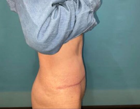 Tummy Tuck: Case 8 - After