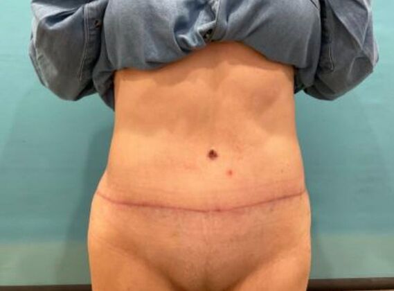 Tummy Tuck Case 8 - After