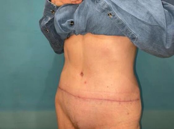Tummy Tuck: Case 8 - After
